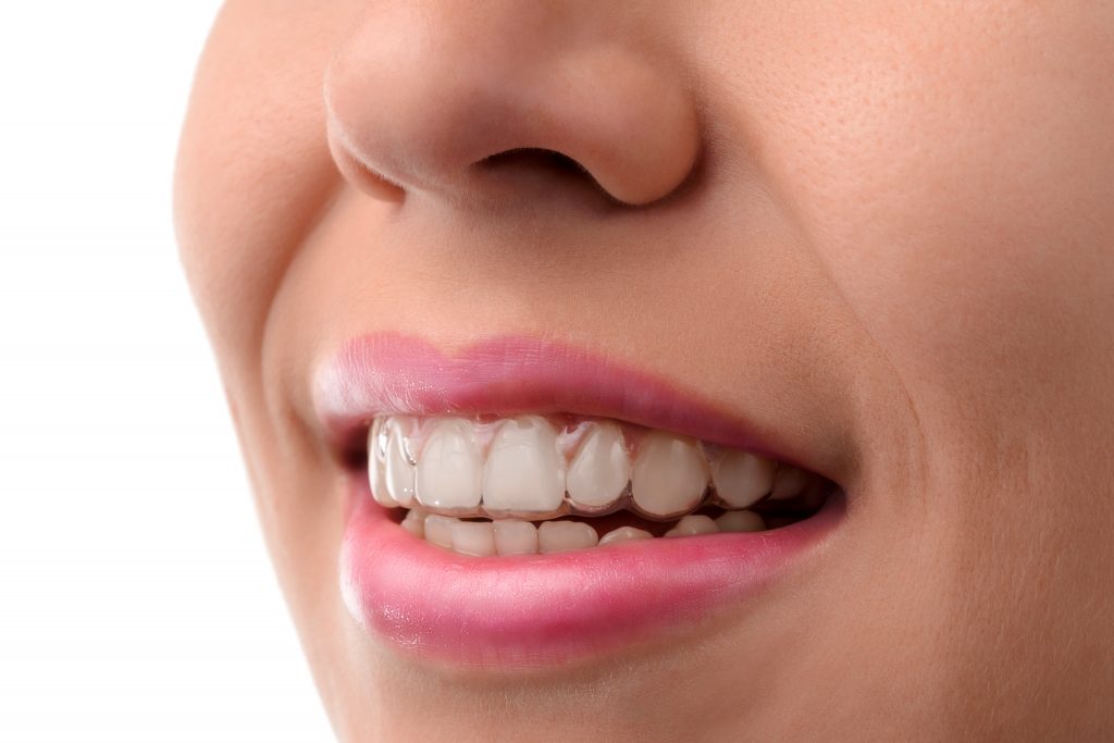 Woman Wearing Invisible Braces